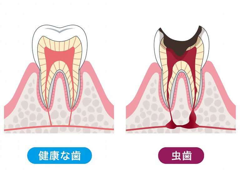 かなり進行