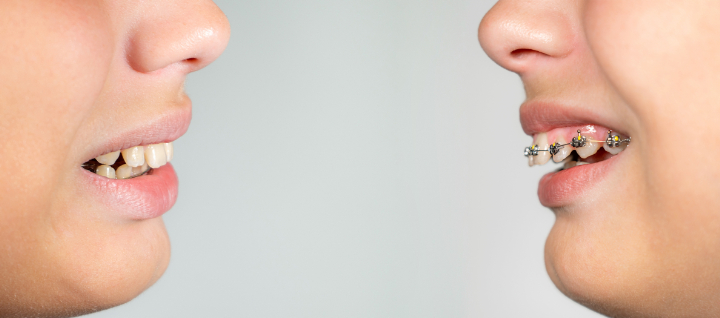 小児矯正を検討したほうがよい歯並びの子ども