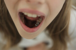 銀歯を見せる女性