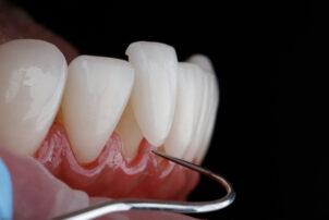 セラミックの歯