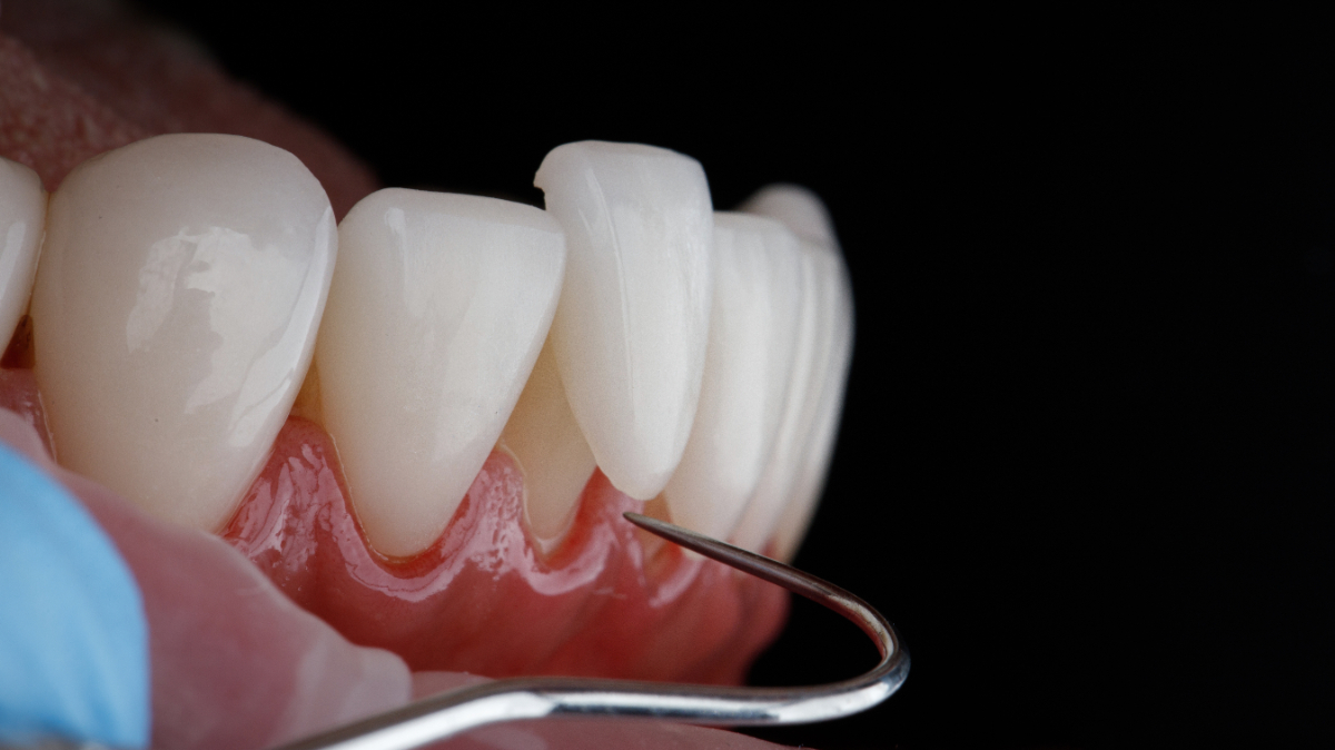 セラミックの歯