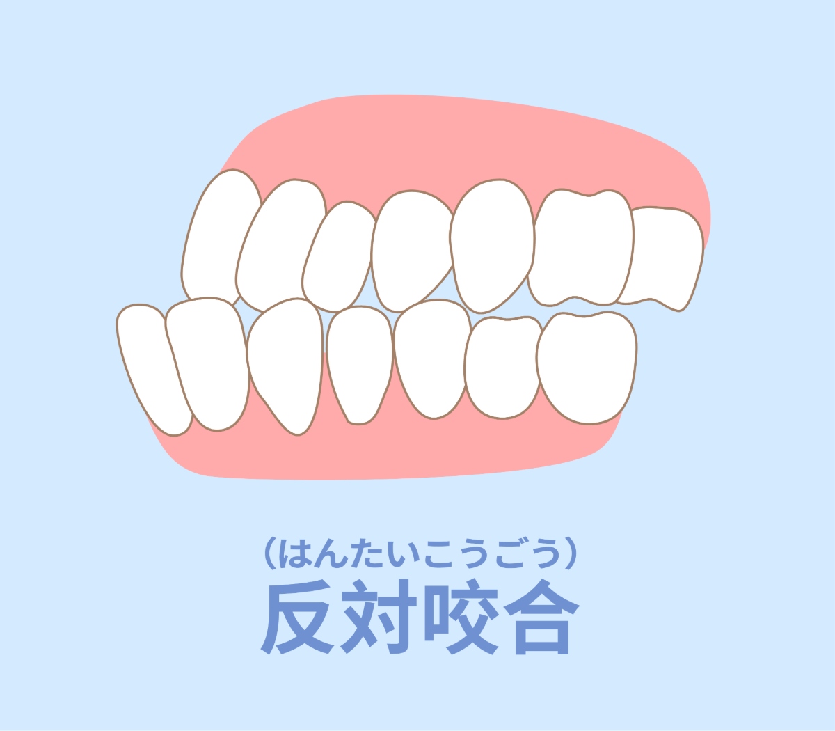 受け口とは